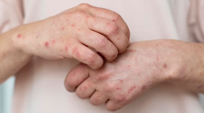 Fungal infection (फंगल इनफेक्शन) 2024