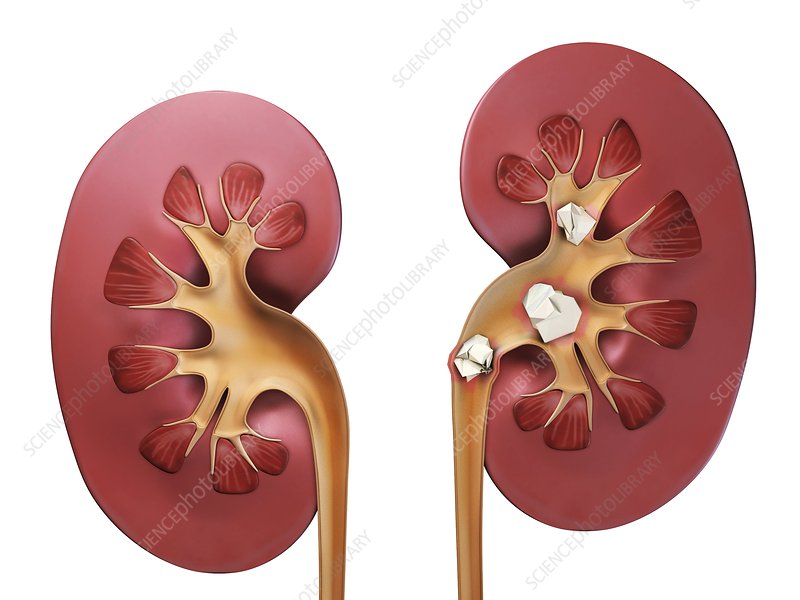 Kidney stones किडनी