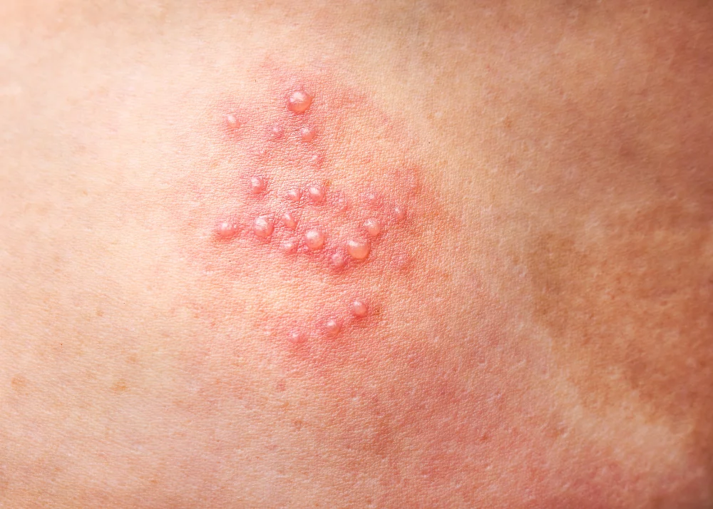 Herpes zoster Disease 5 Symptoms and Remedies