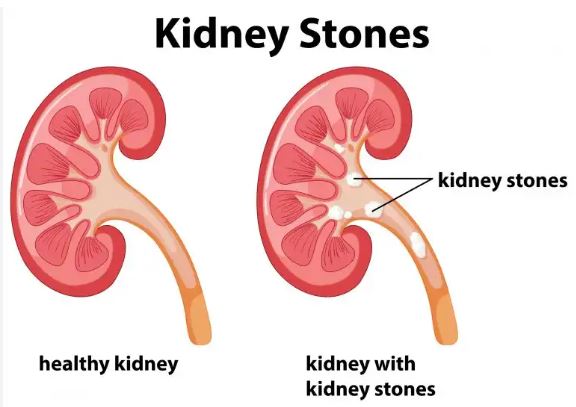 Kidney stones home remedies