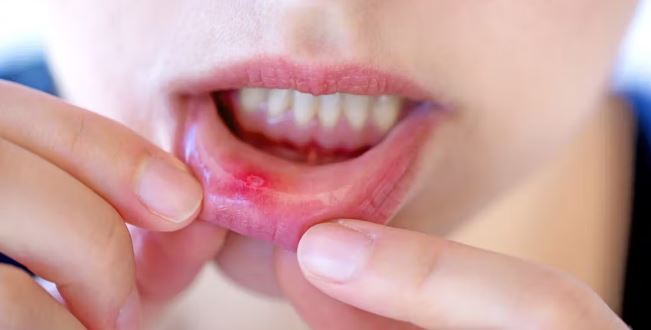 Mouth Sore/ulcer What To Do 24