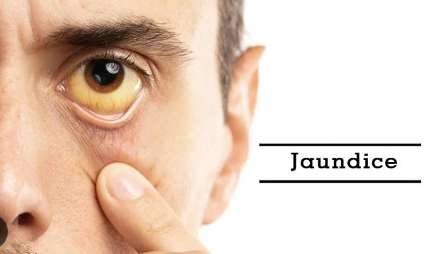 05 Home Remedies for Jaundice