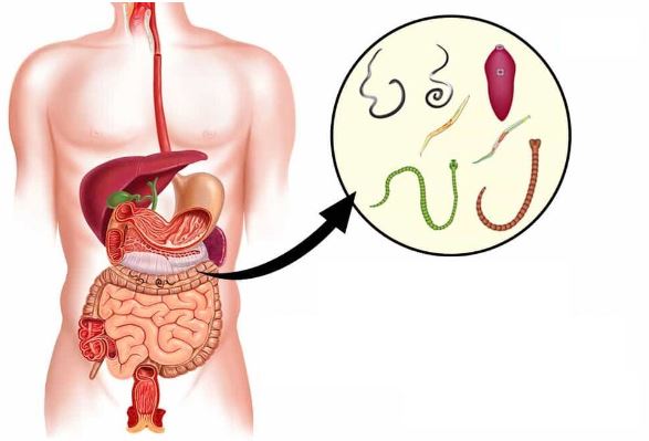 9 Symptoms of Stomach Worms