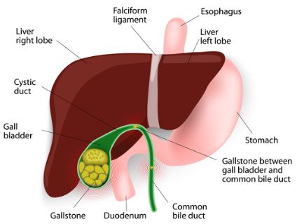 10 Causes of Gallstones and Their Remedies