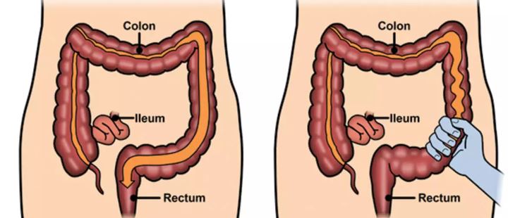 Irritable Bowel Syndrome