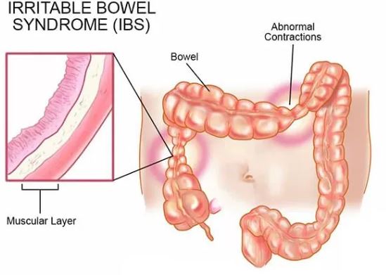 Irritable Bowel Syndrome