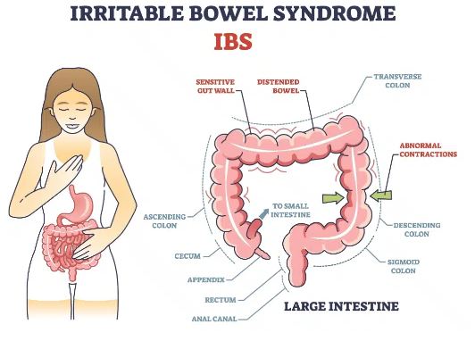 Irritable Bowel Syndrome