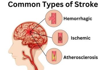 What is Brain Stroke?